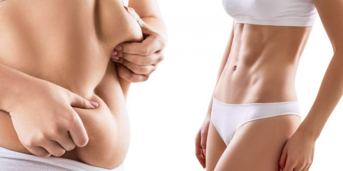 Achieve Your Dream Body with Liposuction Philadelphia