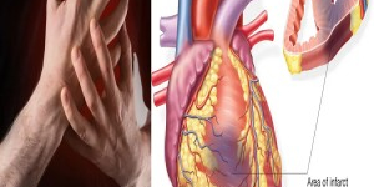 Understanding the Impact of Myocardial Infarction on Businesses