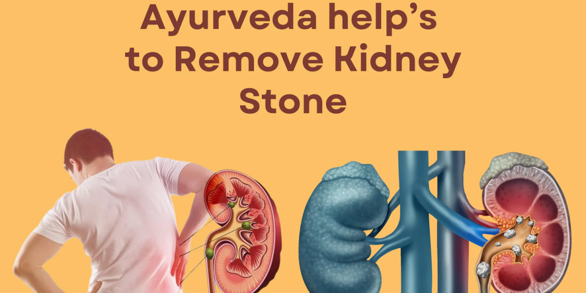 Kidney Stone Ayurvedic Solutions: SL-90 Renal Drop & Stone Removal Capsule