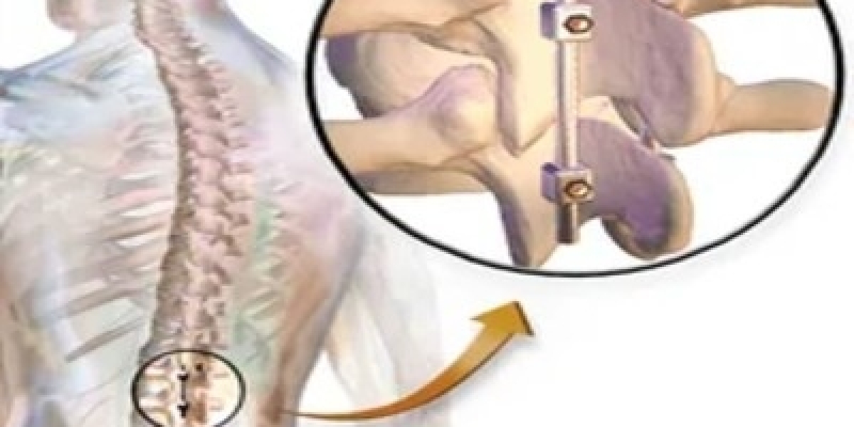 The Revolution in Spine Treatment: Spinal Non Fusion Device